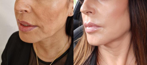 Rejuvenecimiento Facial